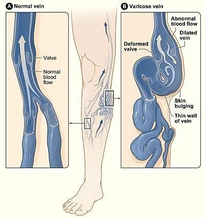 Bệnh giãn tĩnh mạch: Những điều cần biết